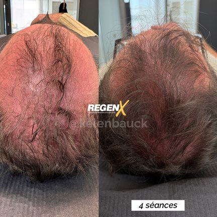 Protocole RegenX, Casteljaloux, Trichopigmentea