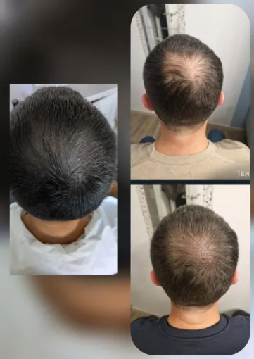 Une alternative à la greffe capillaire pour combler une perte partielle de cheveux à proximité de Marmande, Agen, Trichopigmentea