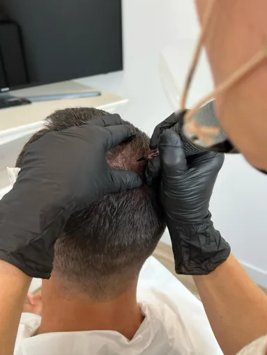Une solution rapide et non invasive pour pallier à une perte partielle de cheveux dans votre salon de tricopigmentation à Casteljaloux dans le Lot-et-Garonne, Casteljaloux, Trichopigmentea