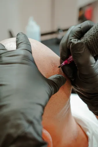La tricopigmentation, une solution pour les problèmes de calvitie, Casteljaloux, Trichopigmentea