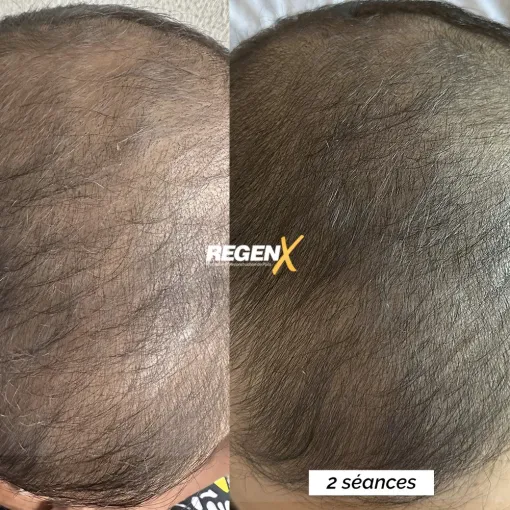 Protocole de repousse des cheveux et tricopigmentation : deux techniques complémentaires pour solutionner vos problèmes de calvitie à proximité de Bordeaux, Casteljaloux, Trichopigmentea