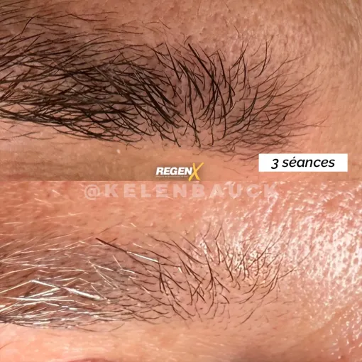Nouveau à côté de Marmande : Le protocole REGEN-X, une solution alternative au microblading, Casteljaloux, Trichopigmentea
