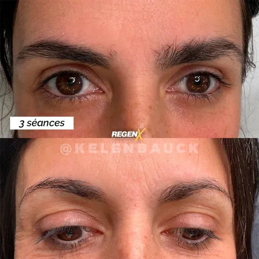 Le protocole RegenX : une alternative aux techniques de microblading et microshading, proposé par Trichopigmentea à Bordeaux., Casteljaloux, Trichopigmentea