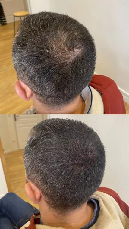 Quelle est la durée de vie d'une tricopigmentation capillaire ?, Agen, Trichopigmentea