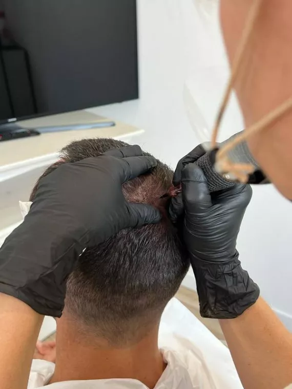 Quels sont les avantages de la tricopigmentation ?, Agen, Trichopigmentea