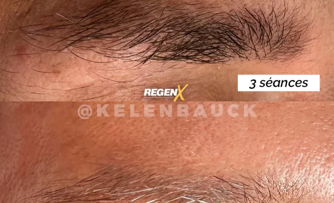 Nouveau à côté de Marmande : Le protocole REGEN-X, une solution alternative au microblading, Casteljaloux, Trichopigmentea