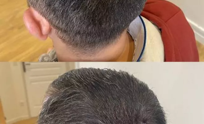 Tricopigmentation, Agen, Trichopigmentea